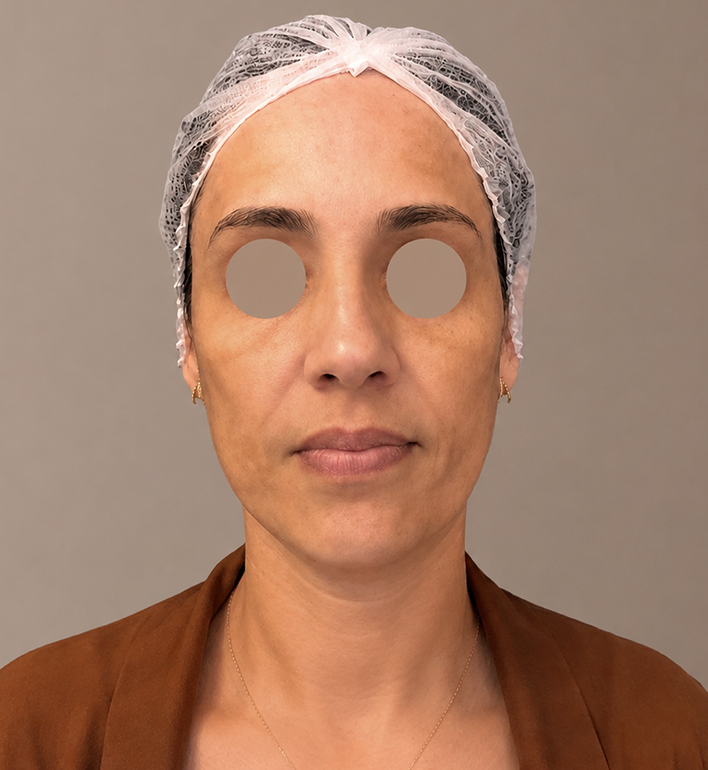 Harmonização Facial - Antes