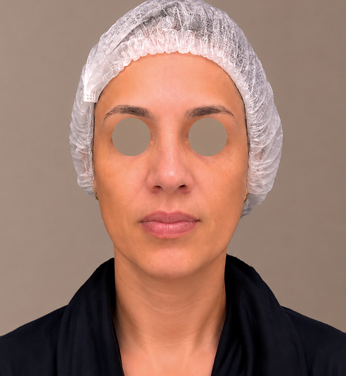 Harmonização Facial - Depois